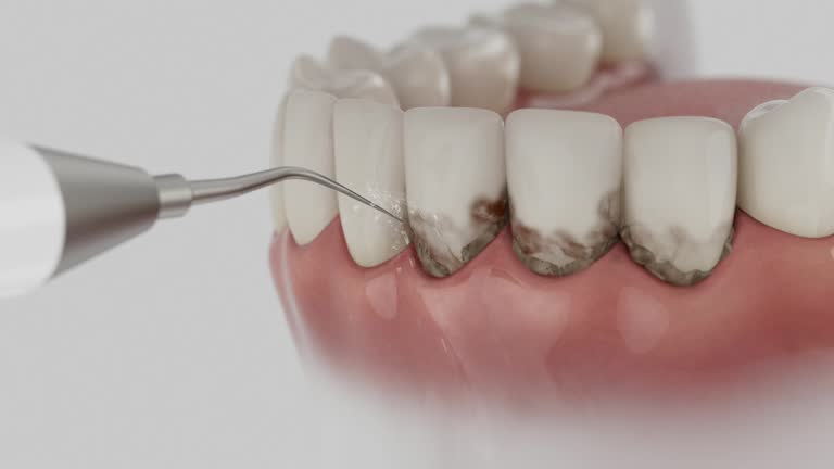 Trusted Wisdom Tooth Removal service in Caldwell, ID - Dentist Open Now